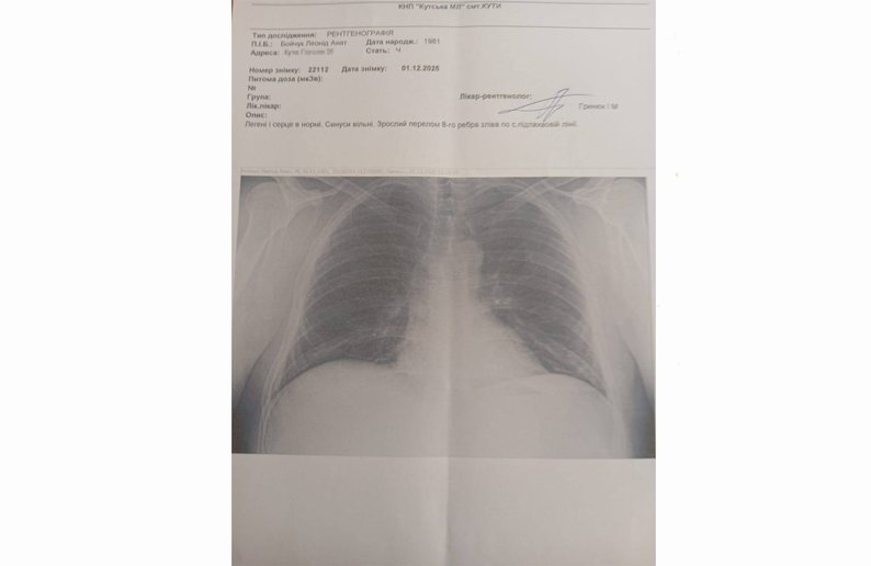 Знімок рентгена грудної клітки Леоніда Бойчука, на якому видно зрослий перелом ребра. Надав Суспільному Леонід Бойчук