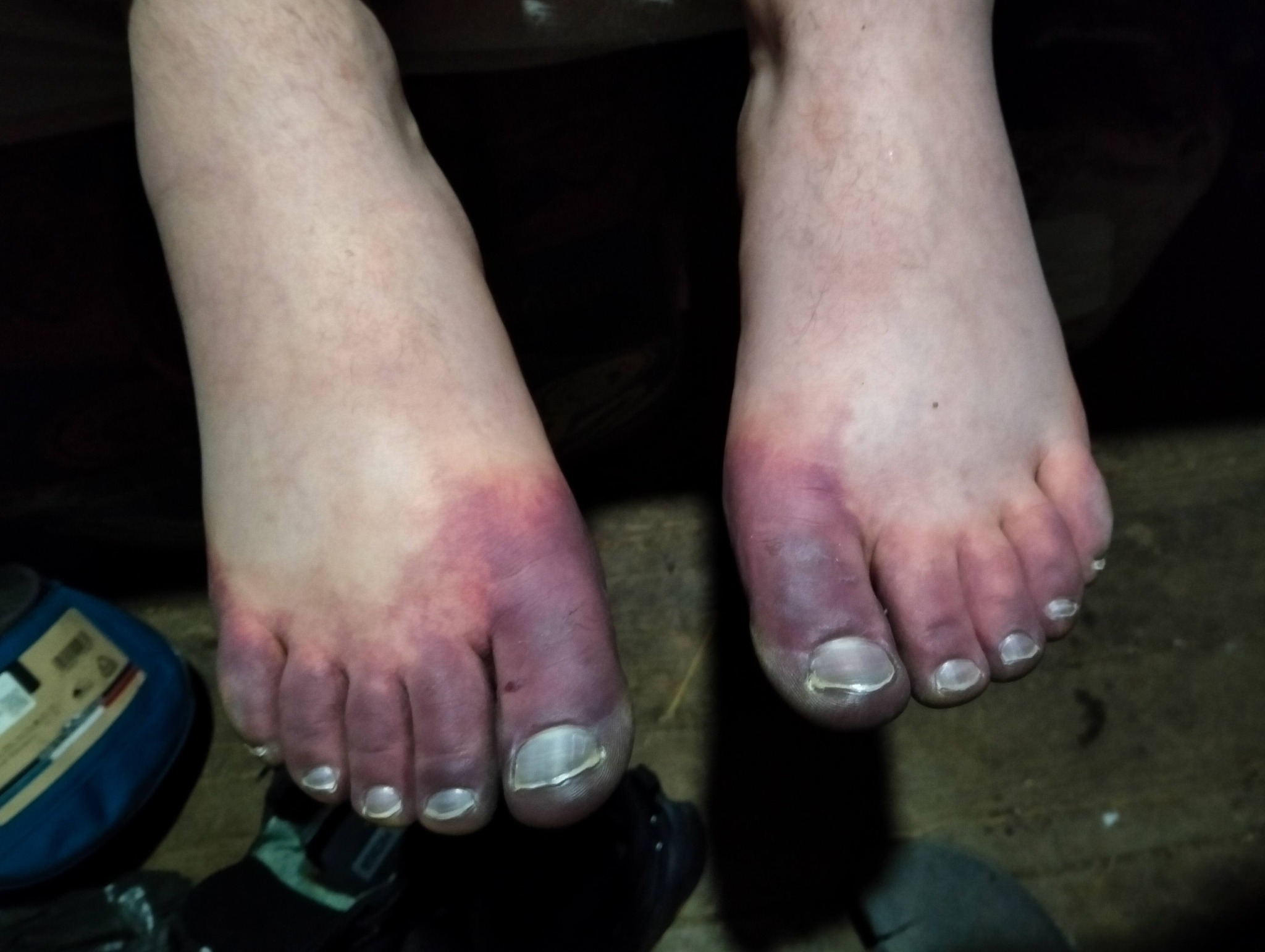 фото: обмороження ніг