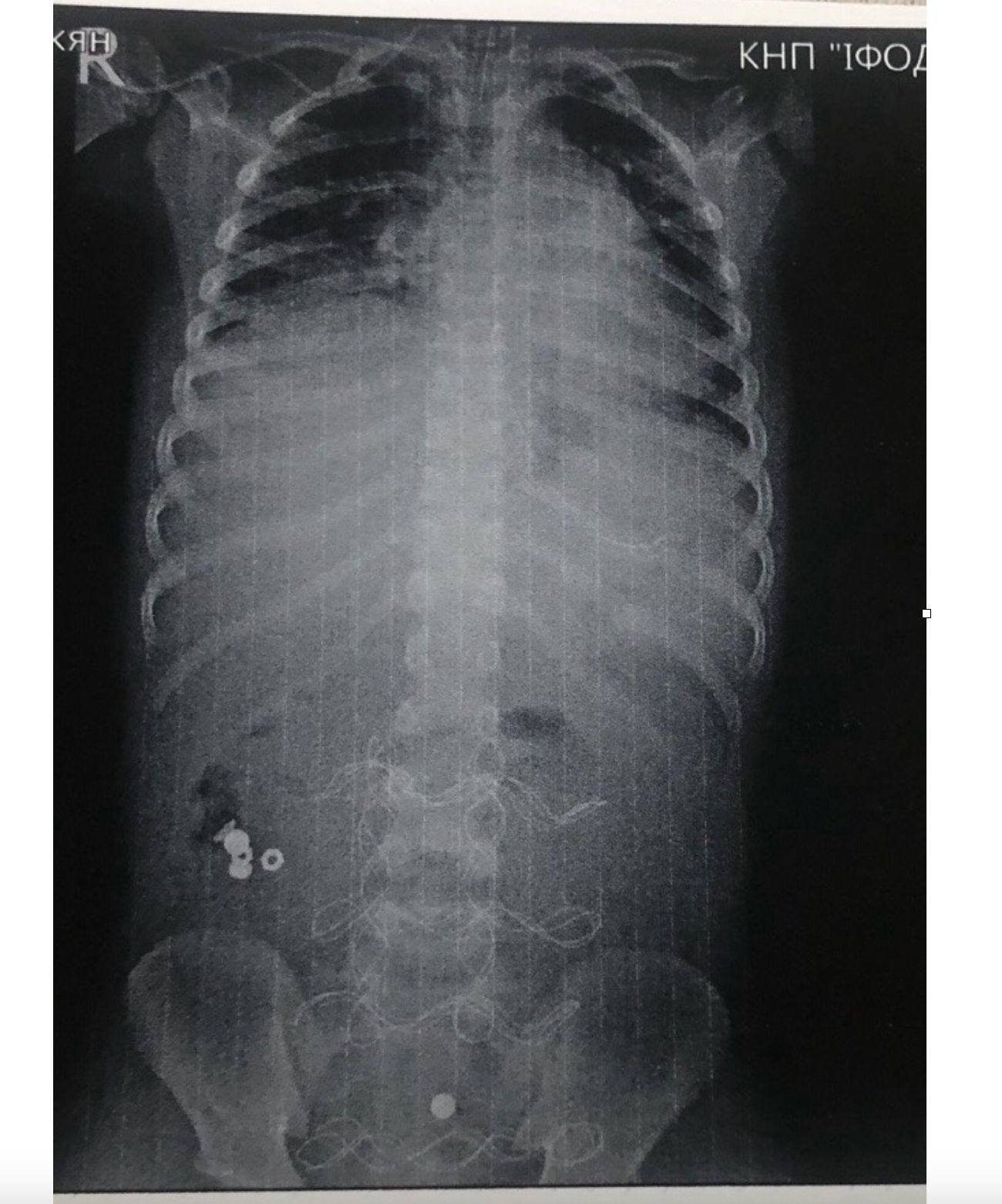 рентгенівський знімок